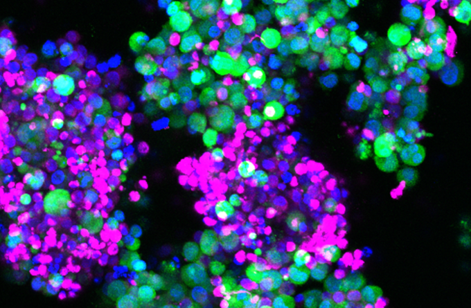 Faster CARs: overcoming cellular exhaustion to enhance cancer immunotherapies